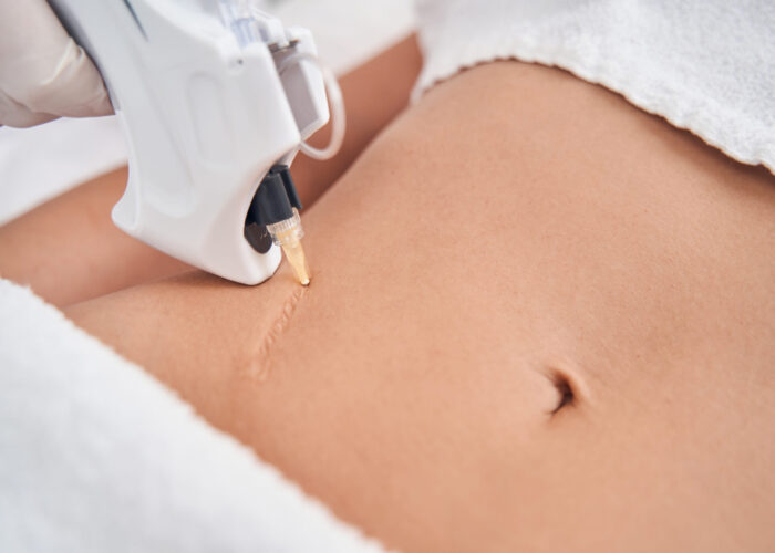 Lasertherapie und NarbenbehandlungUlm Haut