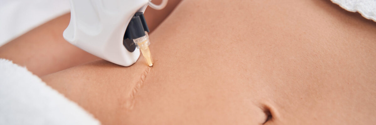 Lasertherapie und NarbenbehandlungUlm Haut